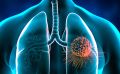 Прислушайтесь к своему организму. Легочная онкология развивается тихо