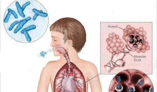 Туберкулез у детей особенно опасен