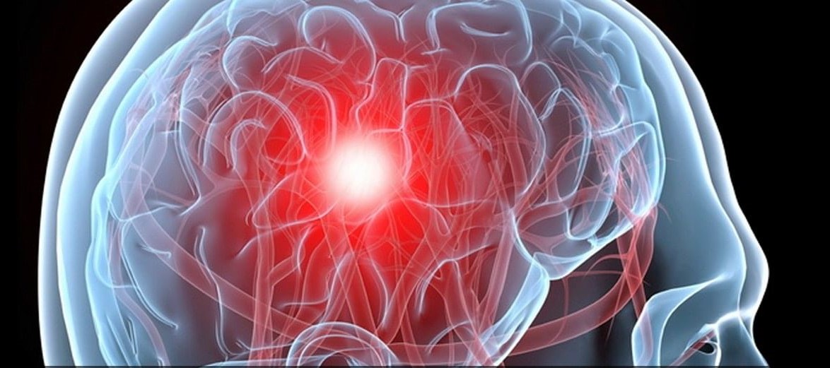 Профилактика инсульта